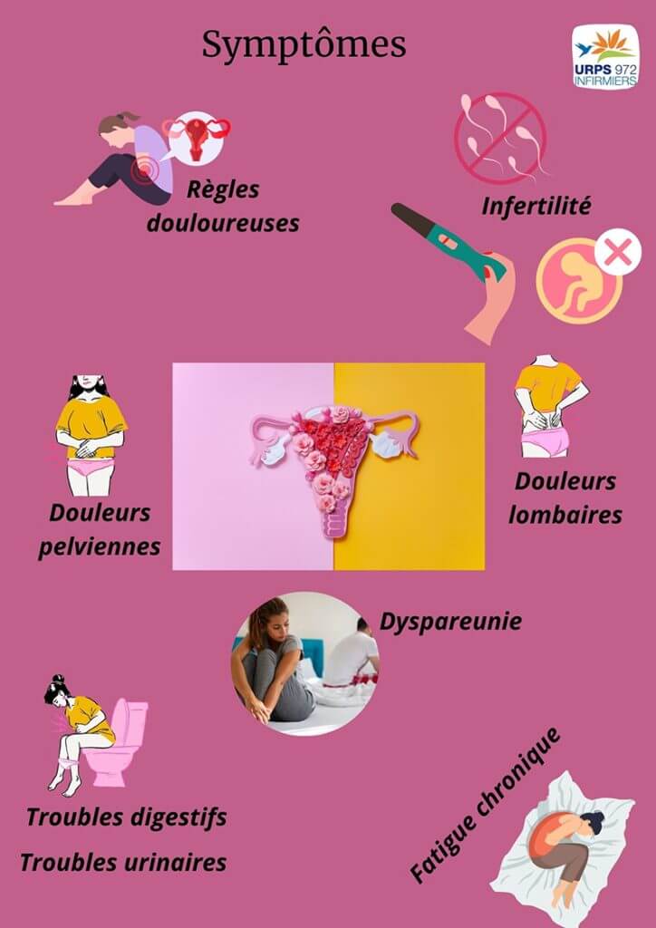 Schéma des symptômes de l'endométriose